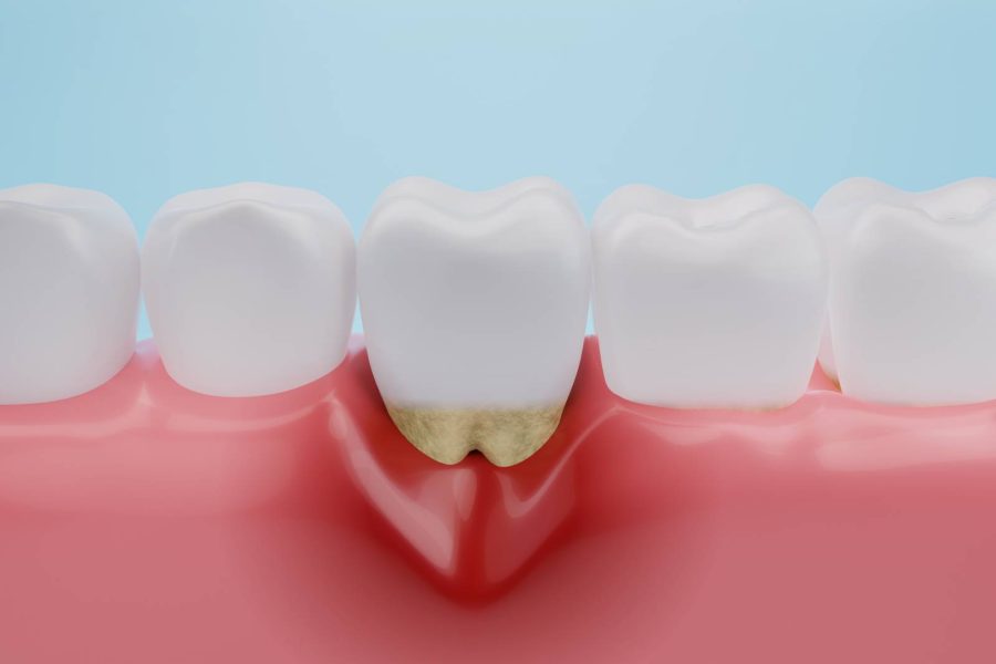 Tartre dentaire : comprendre sa formation et ses risques pour la santé bucco-dentaire