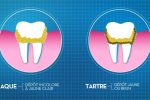 Tartre dentaire : comprendre sa formation et ses risques pour la santé bucco-dentaire