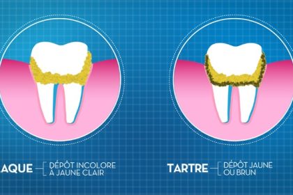 Tartre dentaire : comprendre sa formation et ses risques pour la santé bucco-dentaire