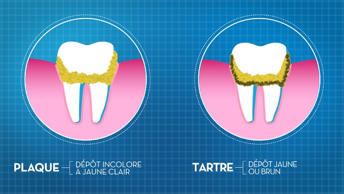 Tartre dentaire : comprendre sa formation et ses risques pour la santé bucco-dentaire